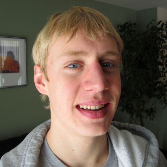 alex-braces-after