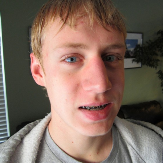 alex-braces-before